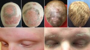 ¿Fin de la calvicie? Descubren tratamiento contra la artritis que hace crecer el cabello