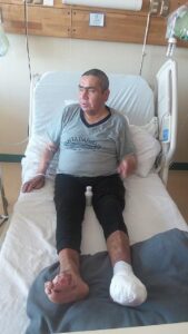 Cocinero vive drama tras sufrir la amputación de siete dedos de sus pies