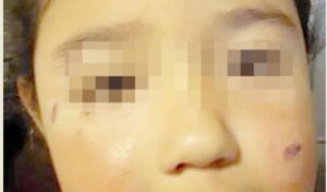 Niña de 5 años sufre heridas en el rostro tras violento ataque de perro callejero