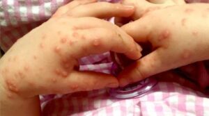 Virus boca, manos y pie no es frecuente en Punta Arenas
