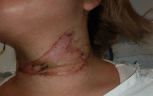 Joven que salvó tras enrollar un cable  con su cuello se querelló contra empresa