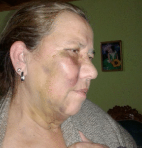 Mujer que estuvo en fatal accidente clama por respuesta del seguro para ser operada