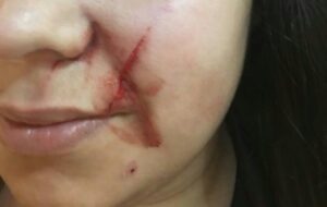 Joven se querelló contra familia que la habría atacado afuera de una discoteque