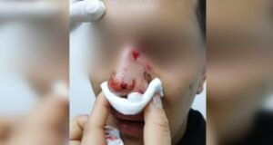 Acusan agresión homofóbica: golpean con puños y botellazos a joven de 20 años en Viña del Mar