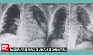 Especialista broncopulmonar explica el Covid-19 en cuadro clínico y radiológico