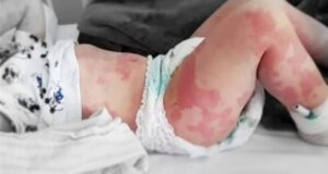 Minsal en alerta por aumento de niños afectados por enfermedad ligada a Covid-19