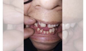 Vecina que perdió sus piezas dentales en Programa “Sonrisa de Mujer” se querelló por presunta negligencia médica