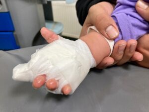 Preocupación por aumento de quemaduras por accidentes caseros durante pandemia