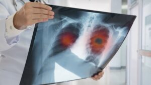 Cáncer de pulmón: La primera causa de muerte en Chile por neoplasias que genera alrededor de 10 decesos por día