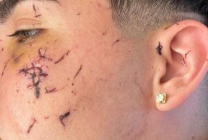 Joven denuncia brutal agresión con gollete de botella al interior de céntrica discoteca