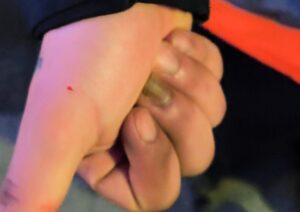 Recolector de basura sufre grave accidente por aguja oculta en bolsa en Población Loteo del Mar